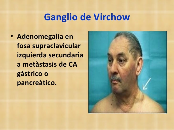 ganglio virchow